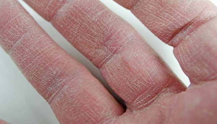 Salep untuk Jari Tangan Kering dan Pecah-pecah