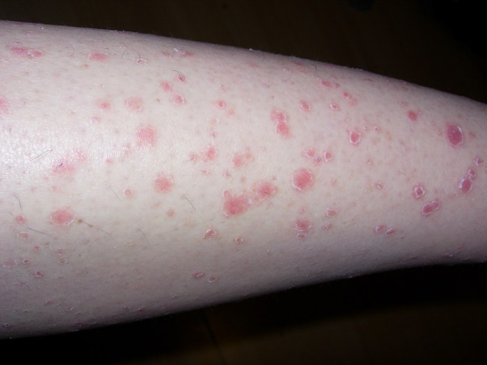 Rash causes erythema multiforme itchy palms blister inflammation remedies rashes painful hives sores allergic itch appear itching raised chilblains
