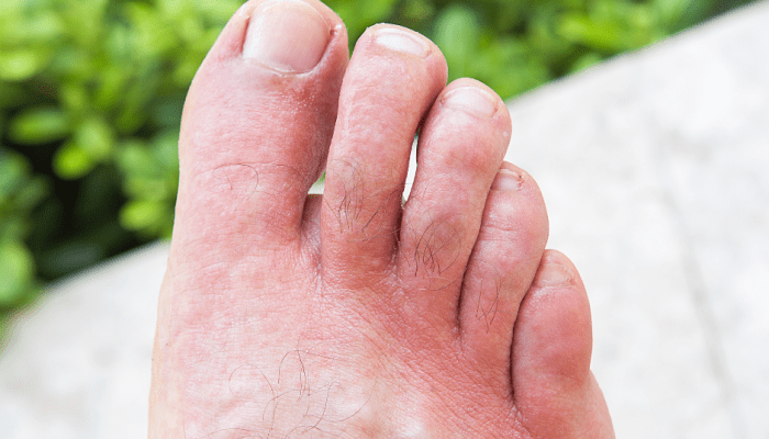 Jari Tangan Bengkak dan Gatal Penyebab dan Penanganannya