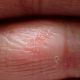 Eczema dermatitis eccema atopic atopica dermatite hands itchy adulti neurodermitis allergy asthma alergia piel nail padeces urticaria linked not fungus