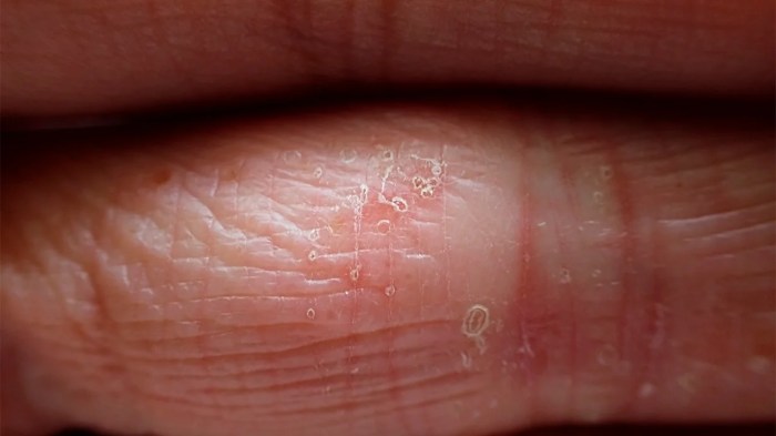 Eczema dermatitis eccema atopic atopica dermatite hands itchy adulti neurodermitis allergy asthma alergia piel nail padeces urticaria linked not fungus
