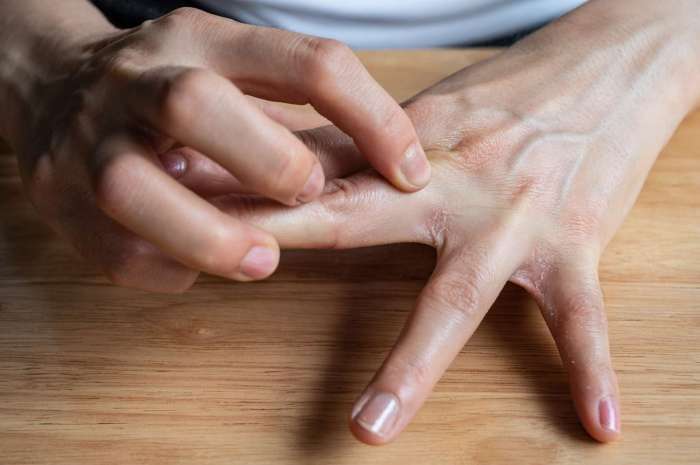 Jari tangan bengkak dan gatal