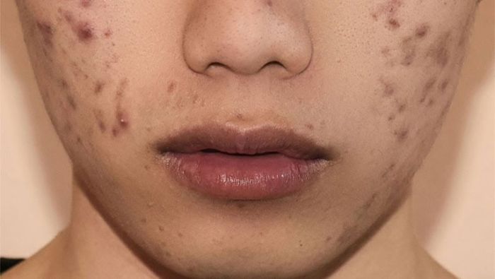 Cara menghilangkan flek hitam