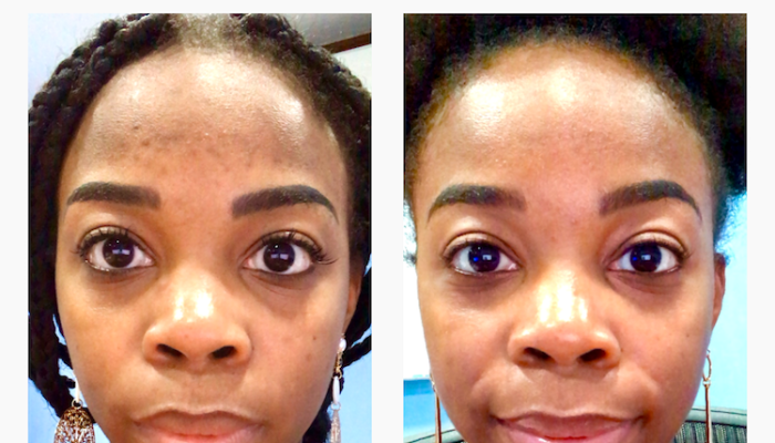 Cara Menghilangkan Flek Hitam Secara Alami dan Medis