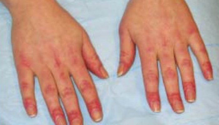 Bintik-bintik di Jari Tangan Tanpa Gatal