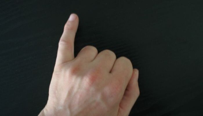 Jari Kelingking Bengkok Penyebab dan Penanganannya