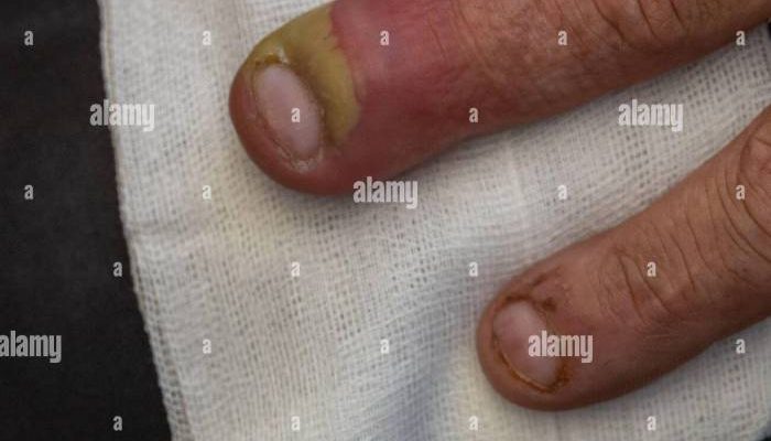 Cara Menghilangkan Nanah di Jari Tangan