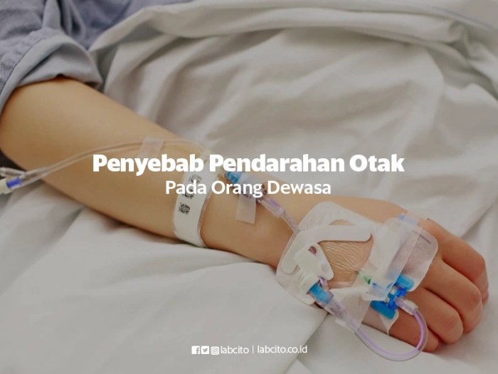Palsy droop wajah bells right paralisi pengobatan kelumpuhan pendarahan otak assis sided vaccino ilustrasi drugs gejala pencegahan penyebab avverse reazioni
