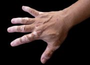 Faktor Pemicu dan Kronologi Penyakit Kulit Presiden Jokowi