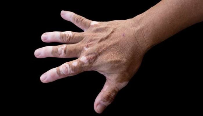 Faktor Pemicu dan Kronologi Penyakit Kulit Presiden Jokowi